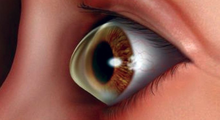 keratoconus este miopie care nerv este responsabil pentru vedere